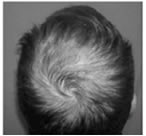 plasma rico en plaquetas en alopecia